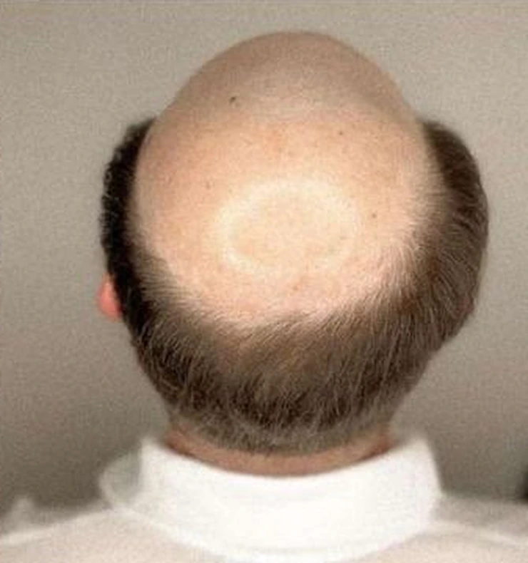 Before: rear view showing significant hair loss at the crown