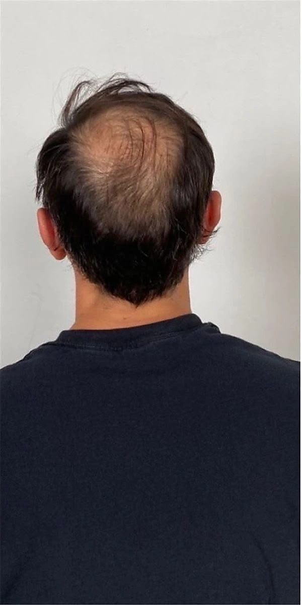 Before: hair thinning and loss at crown